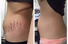 stretch marks weight mark cream stomach after do skin results removal before pregnancy away red works lose tattoo look body