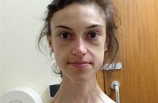 anorexia recovery anorexic weighed just girl remarkable survivor 5st shares emelle lewis