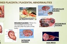 postpartum vagina haemorrhage trauma lacerations