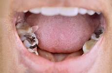 fillings dental cavity cavities teeth dentel symptome causes netdoktor liter happens dentistry