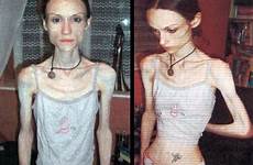 anorexia bulimia eating disorders