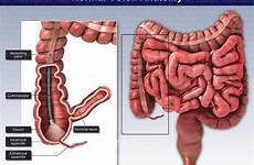 colon away cut ascending appendix