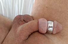 foreskin stretched