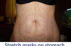 stretch marks stomach mark remedies skin