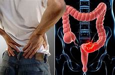 bowel cancer symptoms pain tumour anus passage
