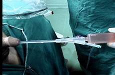 prostate resection transurethral irrigation