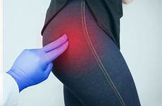 buttock bursitis sciatica buttocks piernas dolor gluteal trochanteric causas posibles relieve dimaksud piriformis gejala physical therapy ciática