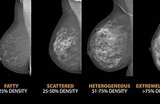 breast density does women cancer breasts do dense tissue womans matter really why age milk before some risk higher they