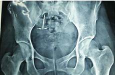 copper pelvis intrauterine