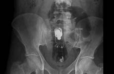 xray rectal anus butt radiopaedia xrays radiology colon abdominal into inflating buyxraysonline misadventure annotated