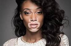 harlow winnie chantelle young brown photoshoot model vitiligo unusual modelo mulheres 1k negra meninas tumblr women mulher faces very top