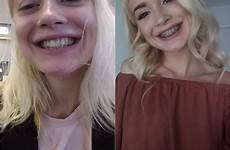 anastasia knight teen her face brace braces anyone forward looking facial comments tf themed sign some braceface reddit first cumshot