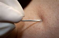 needle bifurcated agulha perto smallpox detalhes bifurcada pixnio respirators cc0