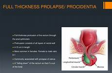prolapse rectal rectum thickness mucosal