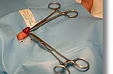 circumcision benefits medical ayon sa topics july