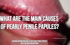 penile papules pearly