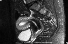 mri cervix vaginal uterus vagina canal internal tampon septum open cm openi small cyclical hematuria fistula during sphincter show