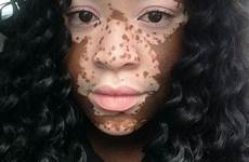 vitiligo model skin beauty treatment disorder people grafting body