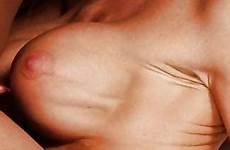rippling implant boob wrinkling