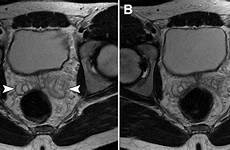 ejaculation prostate imaging adjacent qualitative quantitative anatomic radiol radiology