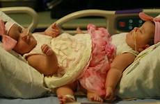 conjoined texas twin twins surgery girls separated set torres hernandez separate