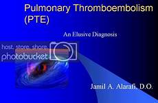 embolism pulmonary gif