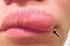 lip lump skin face itchy her after under swollen worm woman upper when moving bump she small facial normal size