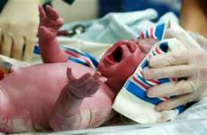 kopf inknippen bevalling labour blutige zwanger samen schwellung neugeborenen alabama permanently injured