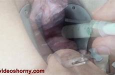 syringe semen insertion uterus