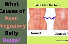 bulge belly causes bulges abdominal abdomen protruding muscles diastasis during recti precisely occurs tissues cells