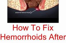 hemorrhoids hemorrhoid rectal internal symptoms