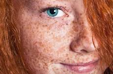 freckle freckles redhead speckled redheads emma gingerparrot