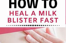 blister breastfeeding blisters heal nipple bleb exclusivepumping