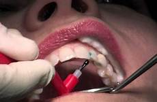 fillings composite dentist cavities amalgam decay dentistry procedures