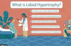 causes labia enlargement hypertrophy labial common nez riaz verywell