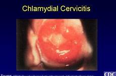 cervicitis speculum chlamydial examination discharge mucopurulent signs endocervical presentation clinical ectopy physical medscape etiology easily bleeding spontaneous induced include may