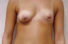 tits lopsided asymmetrical