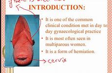 uterine gynaecological prolapse ulcer obstetrics