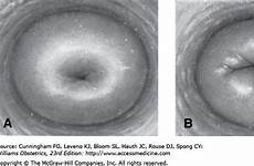 cervix nulliparous parous fertility