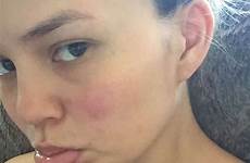 teigen selfie chrissy snapchat acne faire remedy boutons cicatrices disparaitre ans