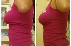 before after works wraps wrap body lift breast surgery love