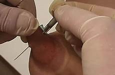 torture needles tumbex