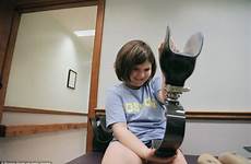 year her she gets 14 richard martin family look first after getting son grins dorchester prosthetics fitted blade joy united