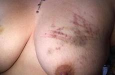 marks bruises beaten torture
