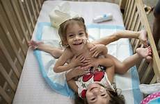 conjoined eva twins erika siamese separated sandoval separation little share digestive uterus telegram joined girls pelvis they surgery their system