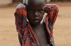 kwashiorkor poverty uganda marasmus perbedaan pxfuel definisi homeless