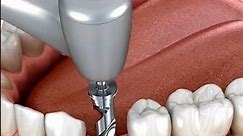 How Do Dental Implants Work 🦷😬 !!!