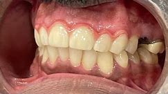 Anterior teeth 🦷 replacement with Zirconia Crown #bilaspur #dentist #dentalclinic