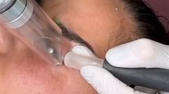 Laser removal of permanent makeup,... - Ageless Body Clinic