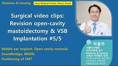 Revision open-cavity mastoidectomy & VSB Implantation #5/5